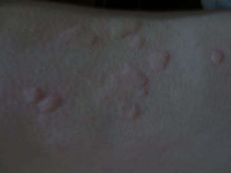蚊子咬的疤怎么去（夏季蚊虫叮咬会留疤？先防时代教你如何处理） | 说明书网