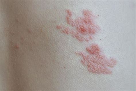 Shingles; Causes, Symptoms and Treatment