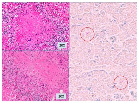 Miliary Tuberculosis Presenting with Hyponatremia and ARDS in an 82 ...