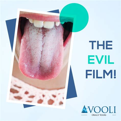 White Film On Tongue And Roof Of Mouth at Justin Steven blog