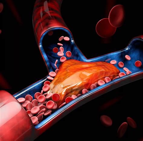 Blood Clot Treatment - Elpis Healthcare