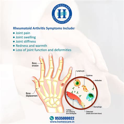 Rheumatoid Arthritis Symptoms | Homeocare International | Flickr