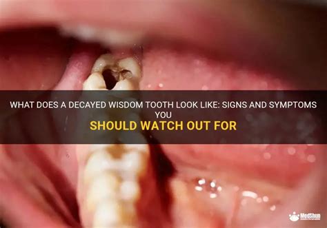 Image result for Wisdom Tooth Decayed