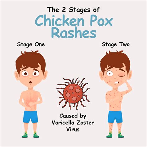 Myths: Separating Fact from Fiction About Chicken Pox | VIMS&RC