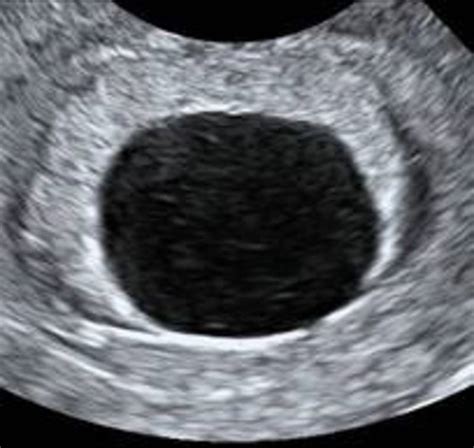 Blighted Ovum At 7 Weeks Blighted Ovum Miscarriage Meaning,