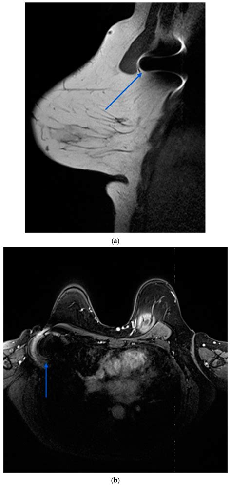 Evaluating Magnetic Seed Localization in Targeted Axillary Dissection ...