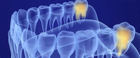 Image result for Basic Tooth Extraction