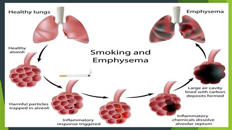 Emphysema Life Expectancy 的图像结果