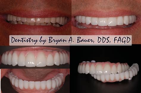 Bauer Dentistry & Orthodontics: Full mouth implant supported bridge