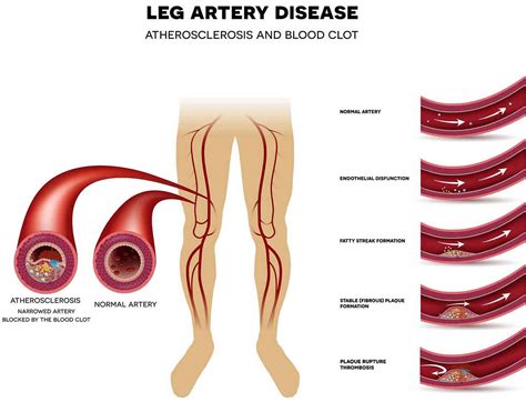 Peripheral vascular disease causes, signs, symptoms, diagnosis & treatment
