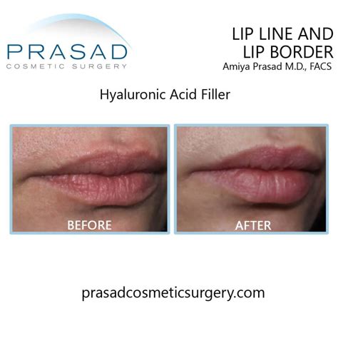 What’s the Best Treatment for Wrinkles Above Lips? | Dr. Prasad Blog
