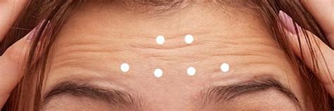 Wrinkle Reduction Treatment of the Frown Lines