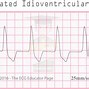 Image result for ventricular