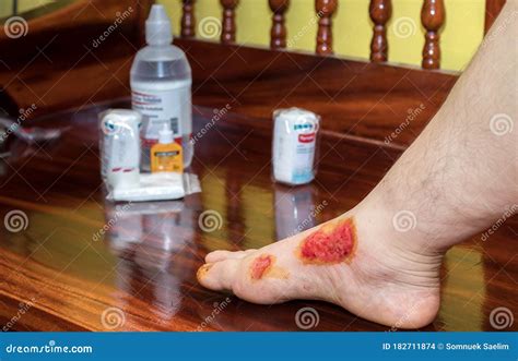 Fresh Blood Blisters on Women S Feet,reflection and Side Effect from Motorcycle Accident Lesion ...