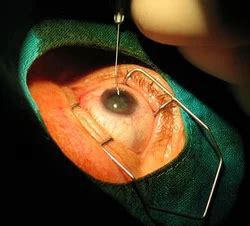 Glaucoma Surgery in Bangalore | Prasad Eye Hospital