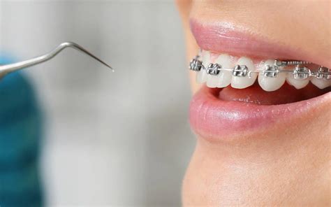 Why Do Braces Brackets Fall Off Sometimes? - Bradford Family Dentistry