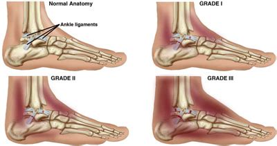 Condition: Ankle Sprain - South Aiken Physical Therapy and Wellness