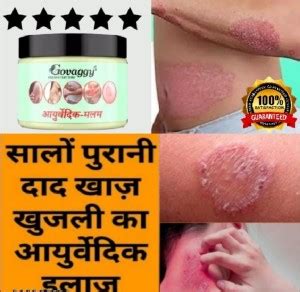 Govaggy 100 % Ayurvedic ItchCoat Anti fungal Malam for Ringworm ...