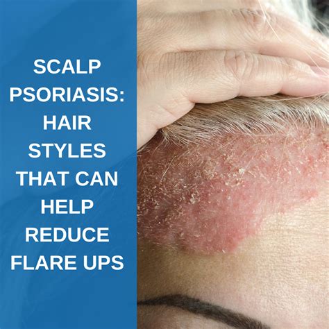 Psoriasis Scalp