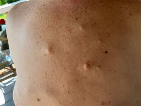 Image result for New Exploding Cysts