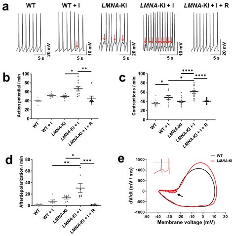 Personalized Medicine Approach in a DCM Patient with LMNA Mutation ...