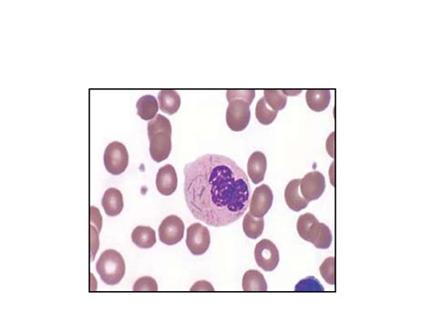 Acute Myeloid Leukemia Classification.pptx