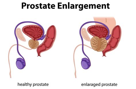 Understanding Prostate Enlargement: Causes & Treatment - Knowledge Mandi