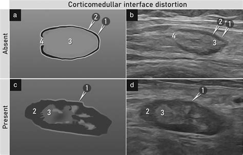 Terms, definitions and measurements to describe sonographic features of lymph nodes: consensus ...