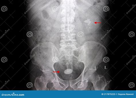 Film of a Patient with Kidney and Urinary Bladder Stones Stock Image - Image of renal, ureter ...