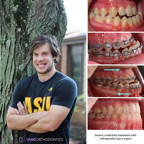 One of our patients at Yang Orthodontics had a severe underbite corrected with braces and ...