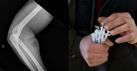 Why So Smart? Man Injects Himself With His Own Semen To Cure Back Pain ...