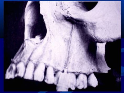Maxillary Local Anesthesia 的图像结果