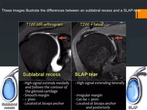 Shoulder labral tears MRI | PPTX