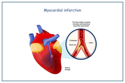 احتشاء عضلة القلب: كيف يمكنني تقليل مخاطر إصابتي بنوبة قلبية؟ | مديكوفر