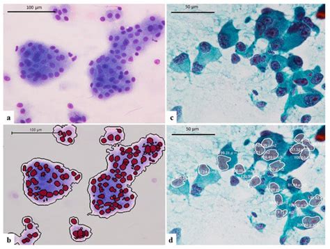 Cytological Comparison between Hepatocellular Carcinoma and ...