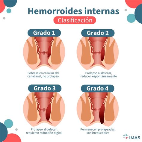 Hemorroidas Internas Vs Externas Externe Hämorrhoiden Rektumstruktur
