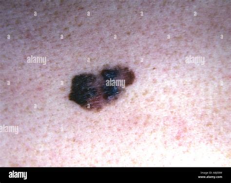Nodular Malignant Melanoma Skin Lesions