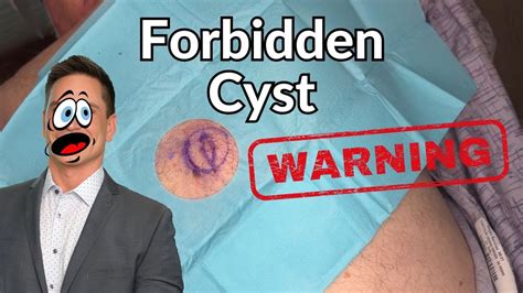 Image result for Cyst Extraction Videos