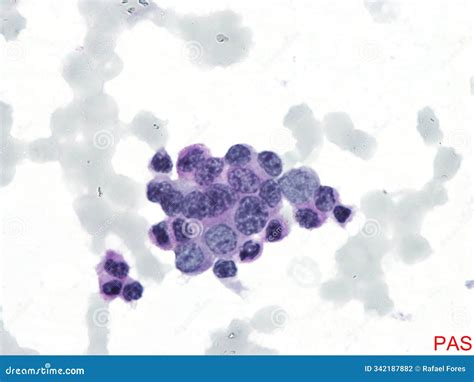 Periodic Acid–Schiff Stain (PAS). Bone Marrow. Stock Photo - Image of ...