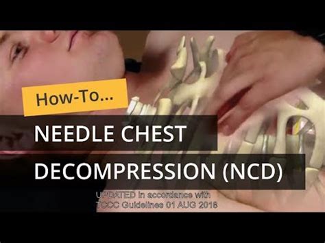 Image result for Locating Needle Decompression Site Using Open Hand as Guide