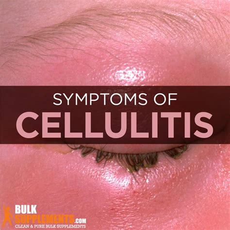 Eye Infection Cellulitis at Larry Cyr blog
