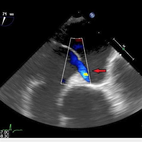 PFO Defect 的图像结果