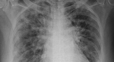 How ISI Kolkata researchers developed Deep Learning tool for COVID-19 ...