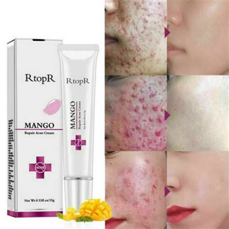 Pimple Scar & Acne Mark Spots Removal Gel Ointment | Ubuy India