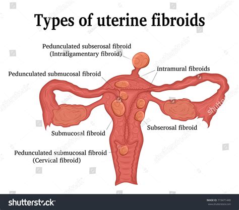 Types Of Fibroids