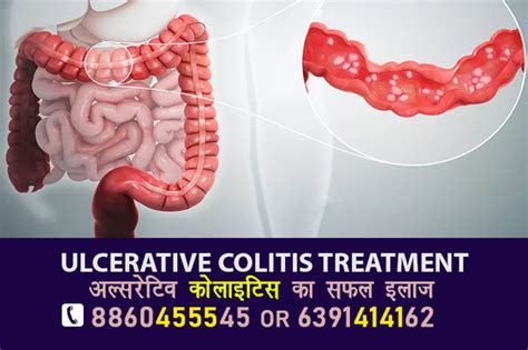 Ulcerative Colitis Treatment Deoria 8860455545 - Lucknow - Click.in
