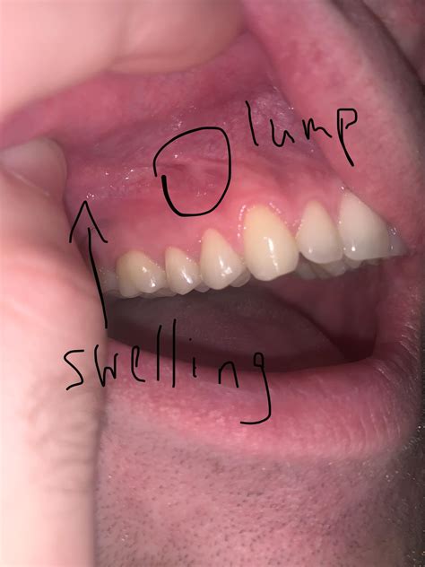 Bosse dure et osseuse sur la gencive supérieure, gonflement à proximité ...
