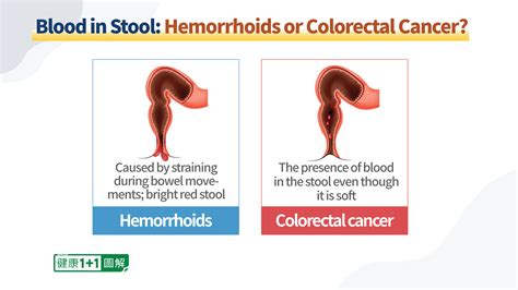 External Hemorrhoid With Blood Clot