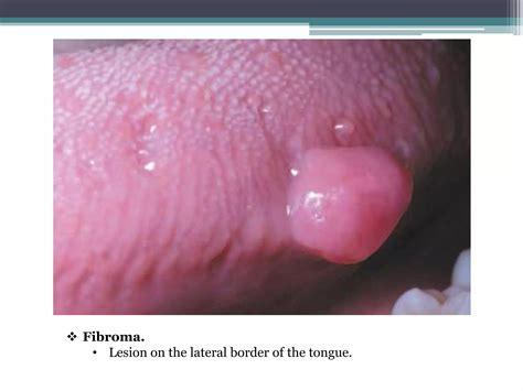 Swellings On The Tongue