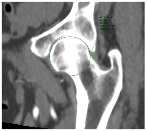 Association of CT-Derived Extracardiac Features and Aortic Annulus Size ...